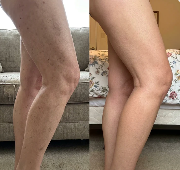 Before and after using Monserae Flawless Body Perfector — Spots & Veins