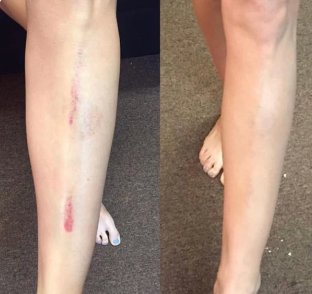 Before and after using Monserae Flawless Body Perfector — Scars