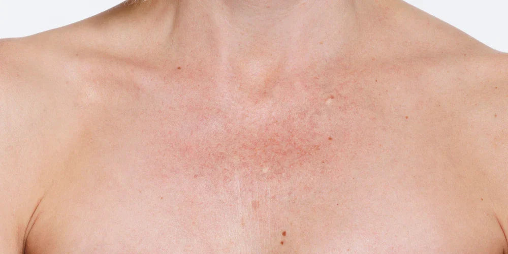 Chest and décolletage before applying Monserae Flawless Body Perfector
